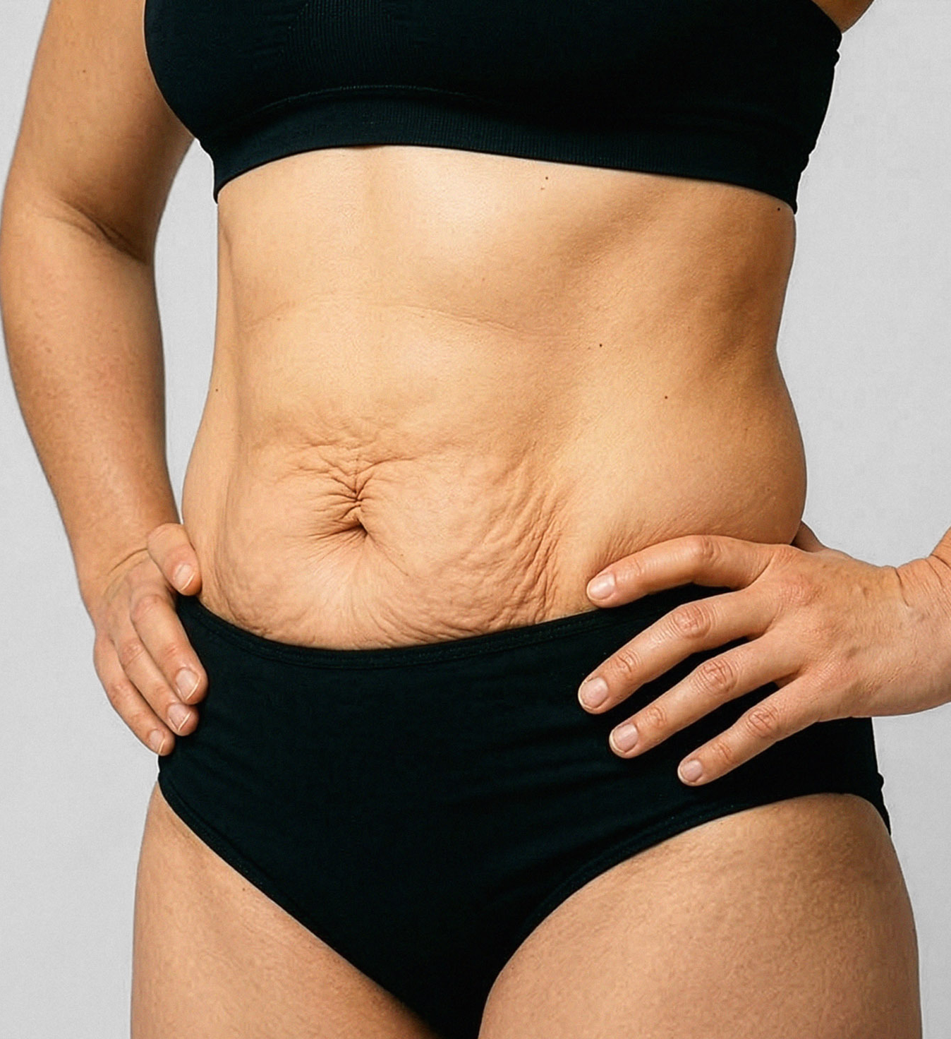 how to avoid loose skin when losing weight on glp-1 Obesity Doctor: Fixing After GLP-1? Ozempic Loose Skin Solutions: Arms,